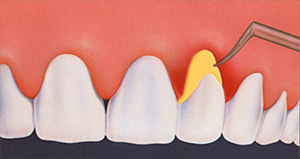 antibiotic treatment