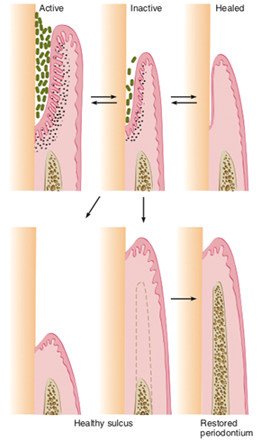 bone regeneration around teeth