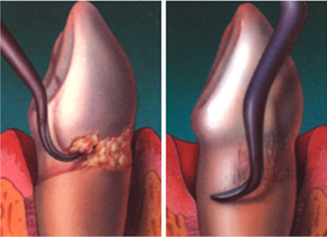 scaling and root planing
