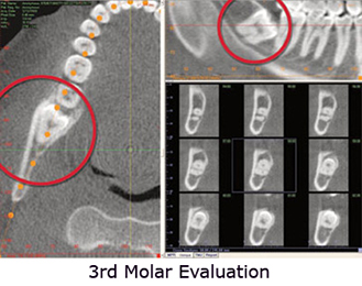 3rd-Molar-Evaluation