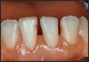 Mucogingival Surgery