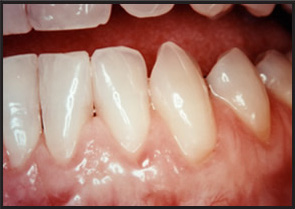 Mucogingival