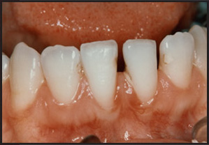 Mucogingival Surgery