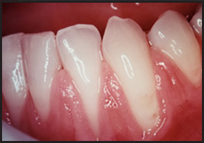 Mucogingival