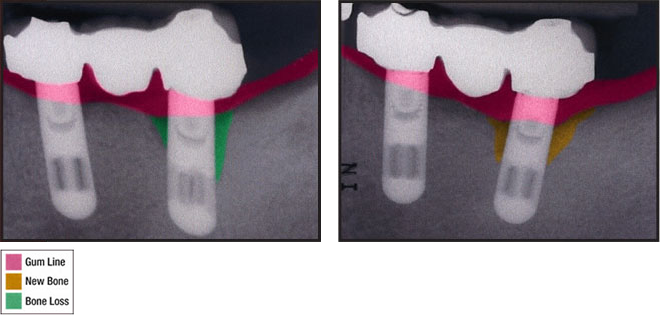 bonyRepair