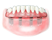 denture