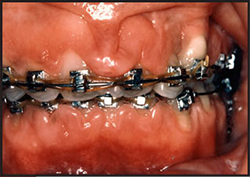 gingival-hyperplasia