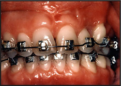 gingival-hyperplasia