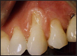 gingival recession