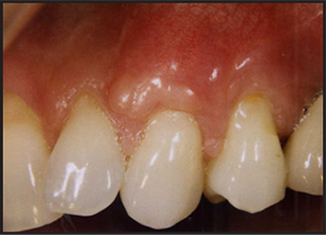 gingival recession