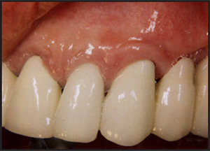 gingival recession