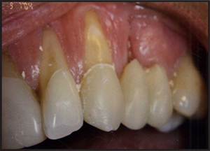 gingival recession