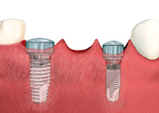 multipletooth