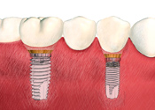 multipletooth