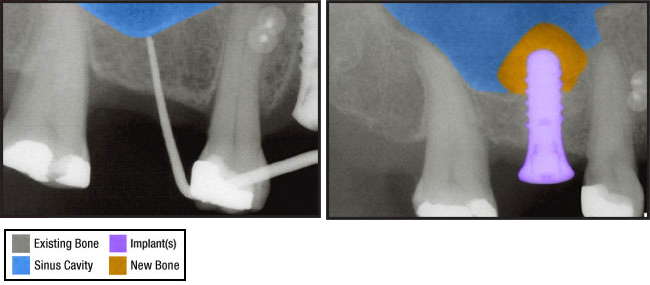 osteotome procedure